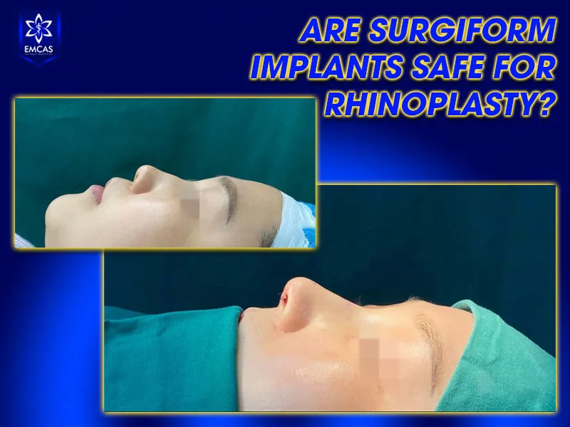 Safety considerations for Surgiform rhinoplasty