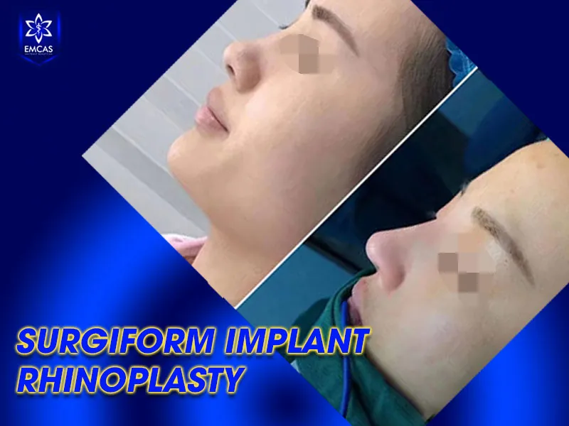 Surgiform rhinoplasty at EMCAS starts from VND 23 million