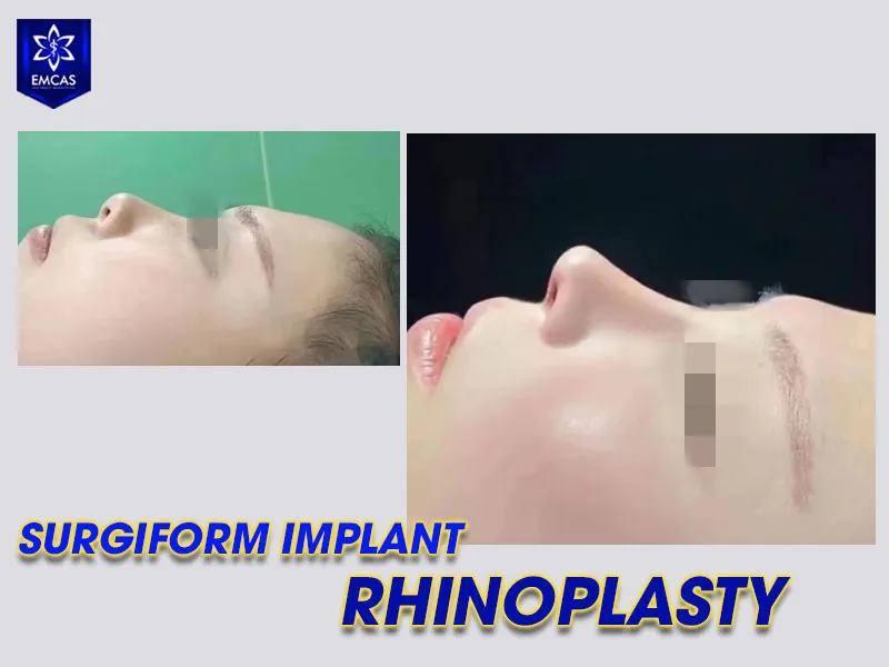 The surgeon, medical facility and implant selection are important considerations before rhinoplasty