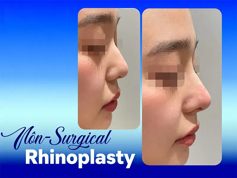 Nonsurgical rhinoplasty may be considered for selected nasal concerns that do not require major structural correction