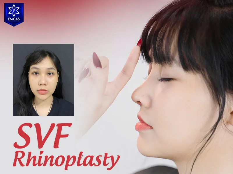 SVF rhinoplasty combines nasal reshaping with stromal vascular fraction derived from autologous fat