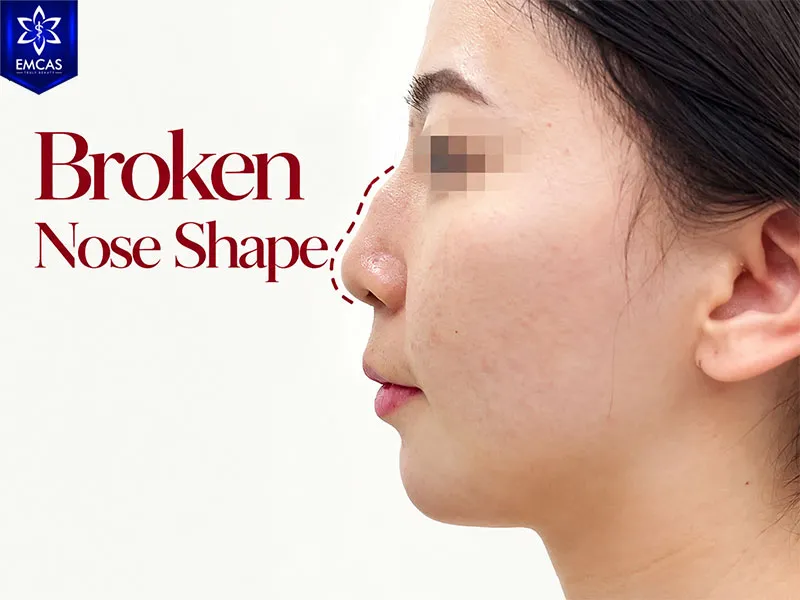 Uneven or interrupted nasal bridge shown in traditional face-reading examples