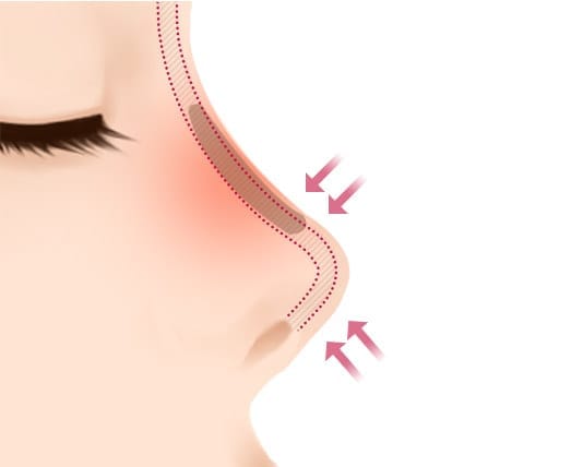 CORRECTIVE/REVISION RHINOPLASTY