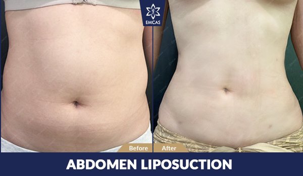 ABDOMEN LIPOSUCTION