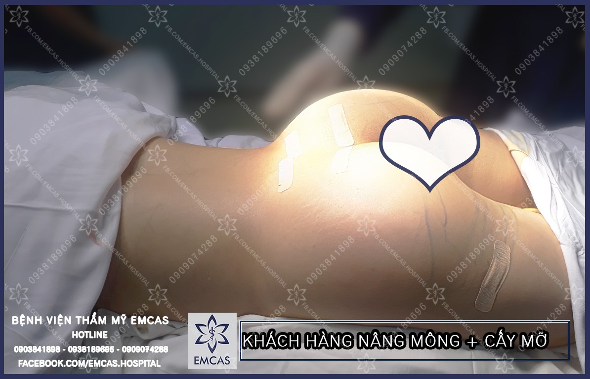 Phẫu Thuật Ngực Mông: Tất Cả Những Gì Bạn Cần Biết