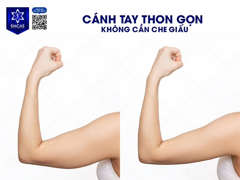 Hút Mỡ Bắp Tay - Phương Pháp Giúp Cánh Tay Săn Chắc, Không Chảy Xệ