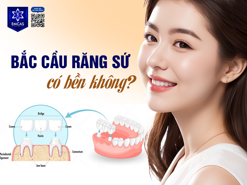 Bắc Cầu Răng Sứ Có Bền Không? Tuổi Thọ Trung Bình Của Răng Sứ