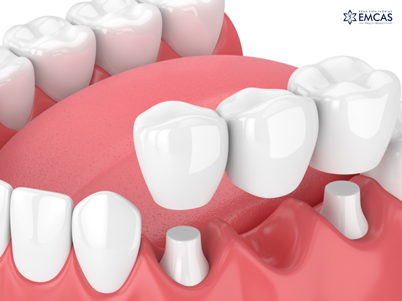 Bắc Cầu Răng Sứ - Giải Pháp Phục Hình Răng Mất Hiệu Quả