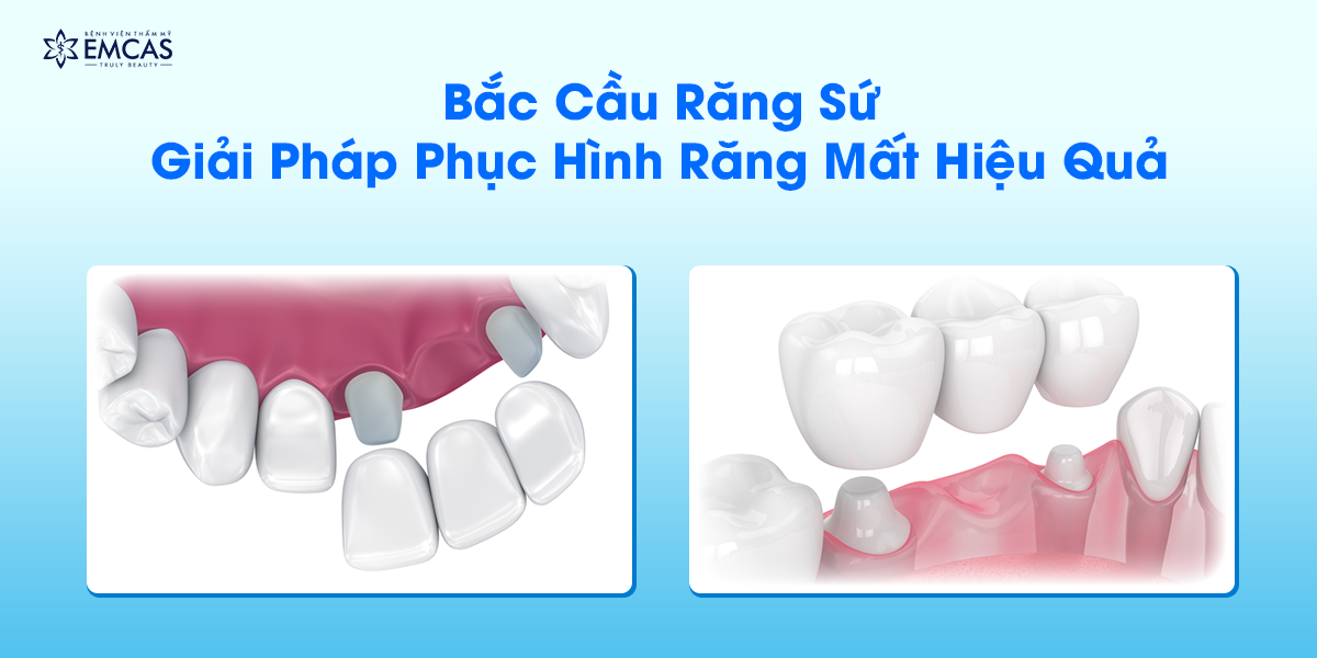 Bắc Cầu Răng Sứ - Giải Pháp Phục Hình Răng Mất Hiệu Quả