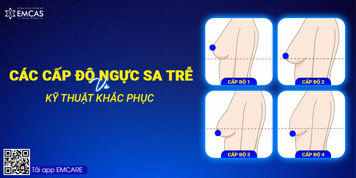 Cấp Độ Sa Trễ Của Ngực Và Kỹ Thuật Khắc Phục