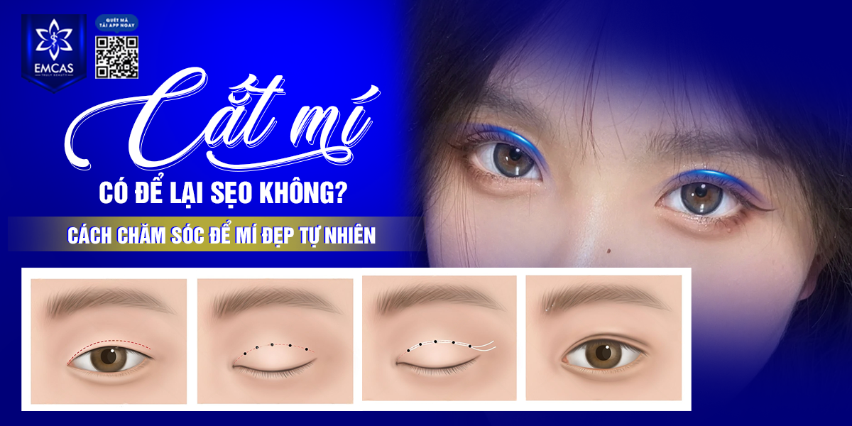 Cắt Mí Có Để Lại Sẹo Không? Cách Chăm Sóc Để Mí Đẹp Tự Nhiên