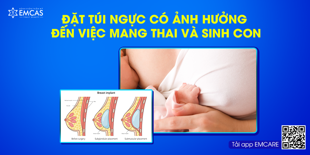 Đặt Túi Ngực Có Ảnh Hưởng Đến Việc Mang Thai Và Sinh Con