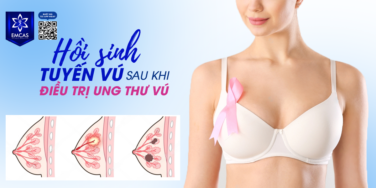 Hồi Sinh Tuyến Vú Sau Khi Điều Trị Ung Thư Vú