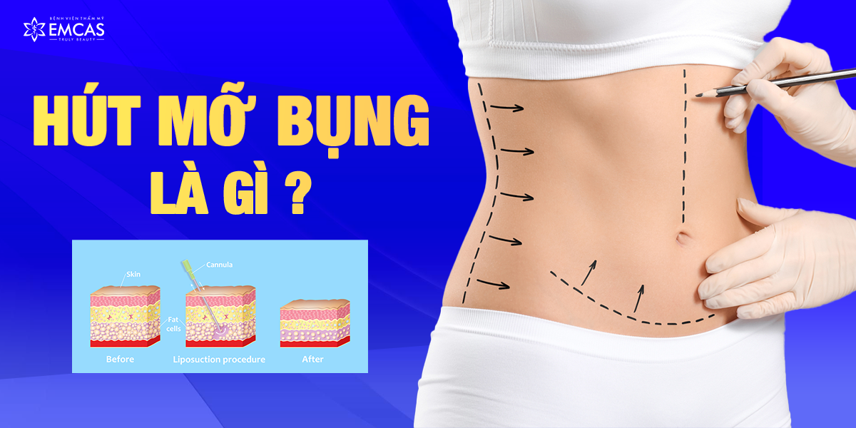 Hút Mỡ Bụng Là Gì?