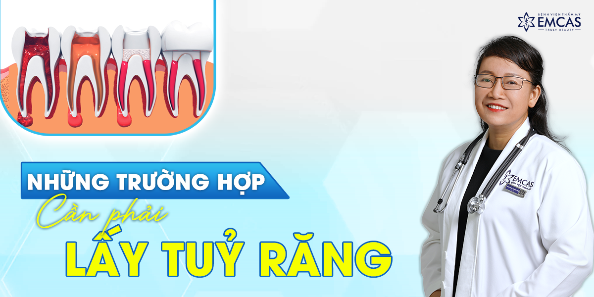 Những Trường Hợp Cần Phải Lấy Tủy Răng