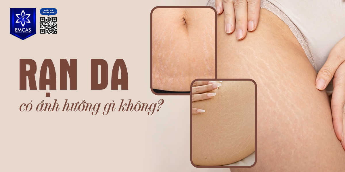 Rạn Da Có Ảnh Hưởng Gì Không?