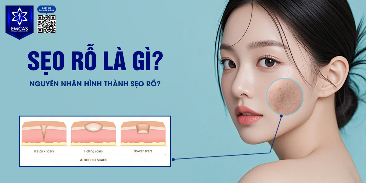 Sẹo Rỗ Là Gì? Nguyên Nhân Hình Thành Sẹo Rỗ?