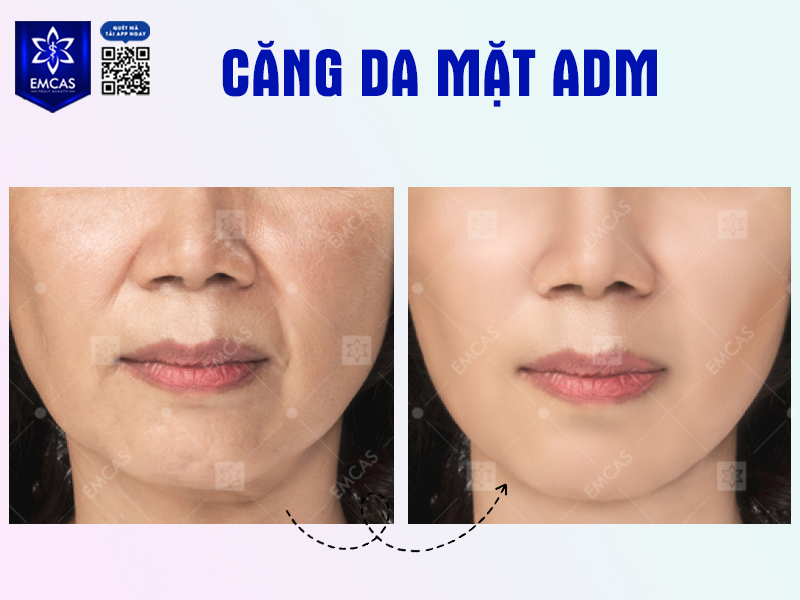 Căng Da Mặt ADM Là Gì? Tất Tần Tật Những Điều Bạn Cần Biết