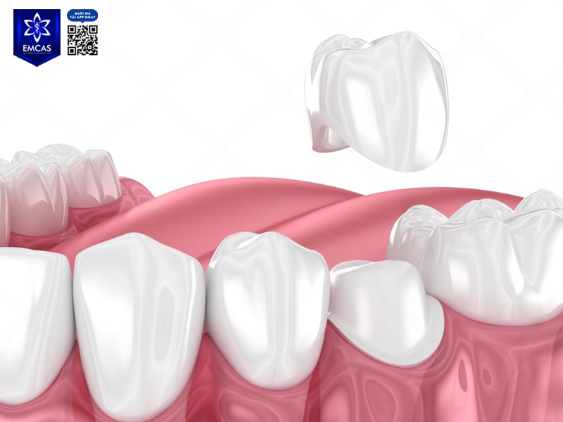 Bọc Răng Sứ Giữ Được Bao Lâu? Những Yếu Tố Ảnh Hưởng Đến Tuổi Thọ