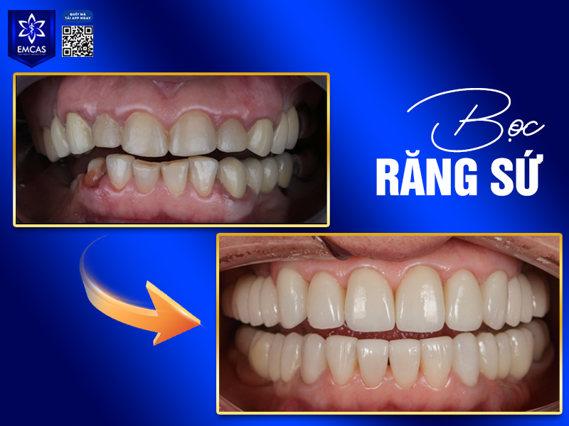 Bọc Răng Sứ Giữ Được Bao Lâu? Những Yếu Tố Ảnh Hưởng Đến Tuổi Thọ