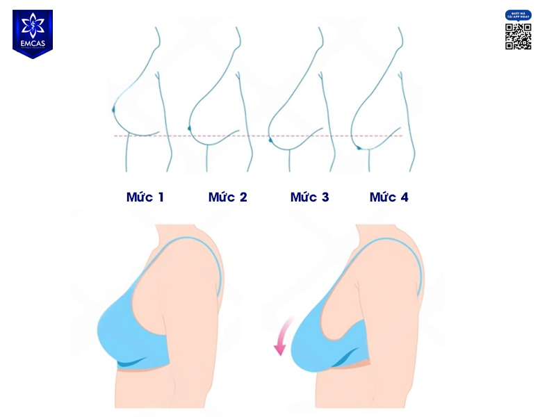 Ngực Chảy Xệ Có Nâng Lên Được Không? Cách Cải Thiện Vòng 1 Sau Sinh