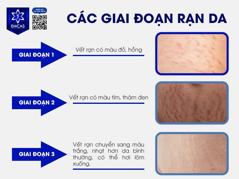 Rạn Da Có Ảnh Hưởng Gì Không?
