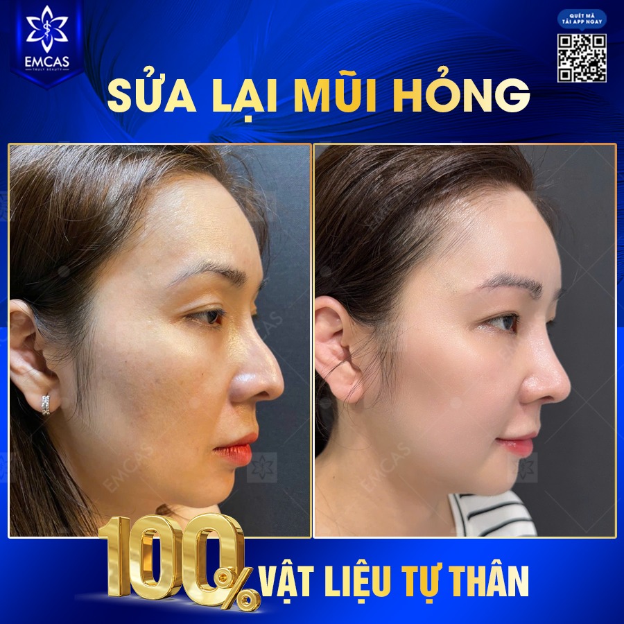 Vì Sao Nên Lựa Chọn Nâng Mũi SVF?