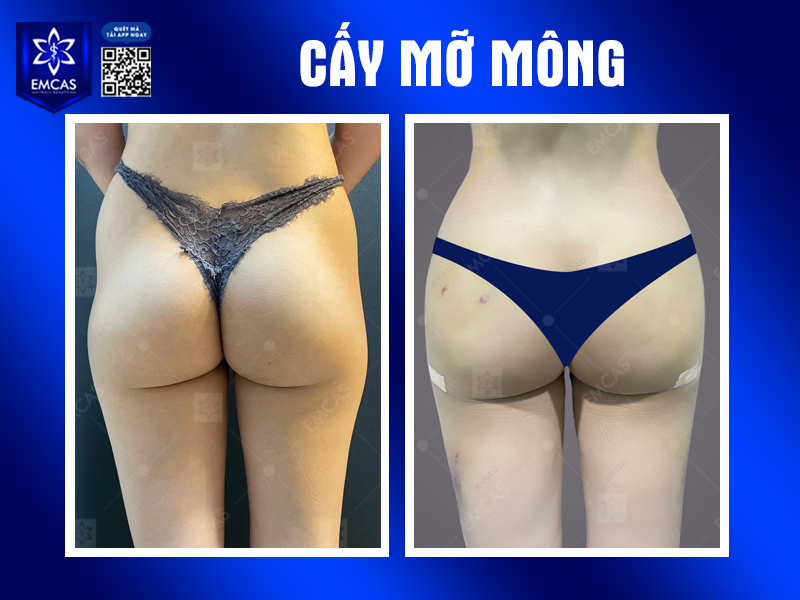 Cấy Mỡ Tự Thân Nâng Mông Có Giữ Được Lâu Không?