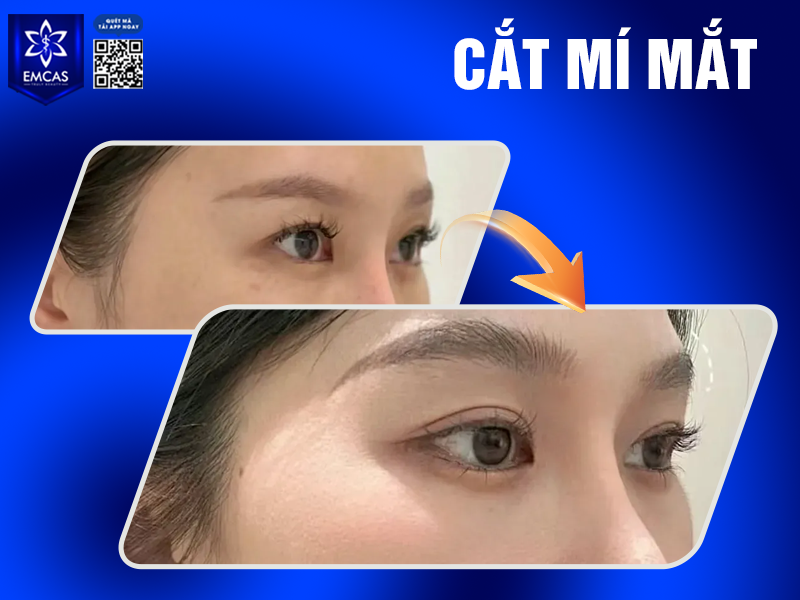Cắt Mí Có Để Lại Sẹo Không? Cách Chăm Sóc Để Mí Đẹp Tự Nhiên