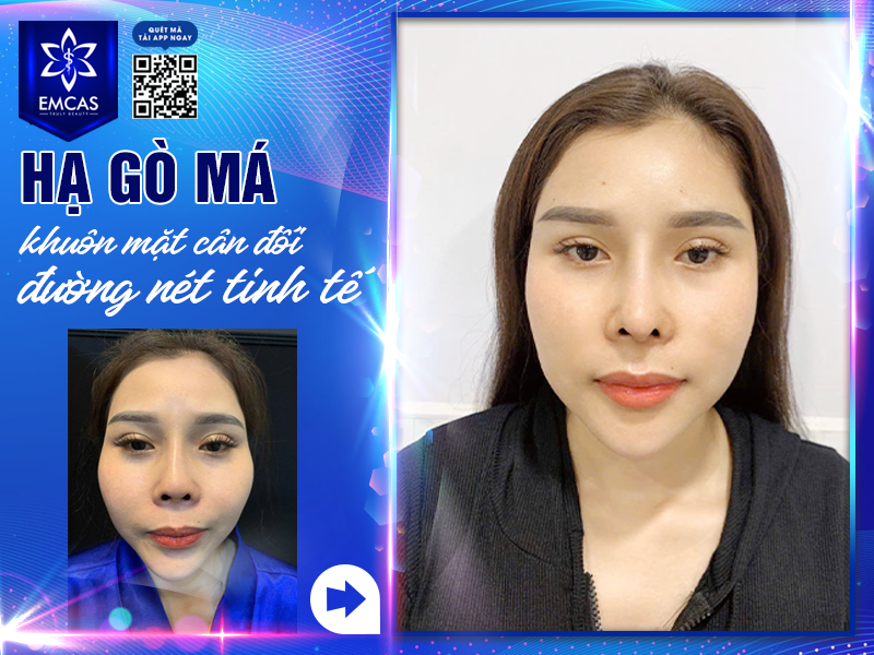 Hạ Gò Má Bao Lâu Thì Lành? Bí Quyết Chăm Sóc Sau Phẫu Thuật
