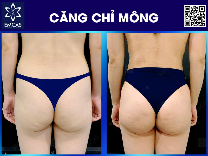 CĂNG CHỈ VÒNG 3