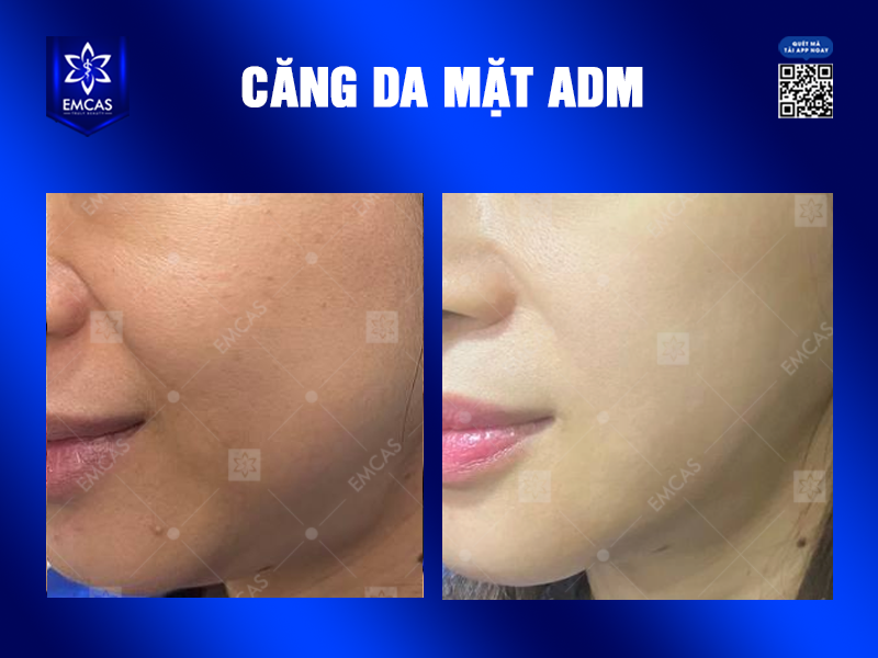Căng Da Mặt ADM Có Thật Sự Hiệu Quả Trong Việc Trẻ Hóa Khuôn Mặt?