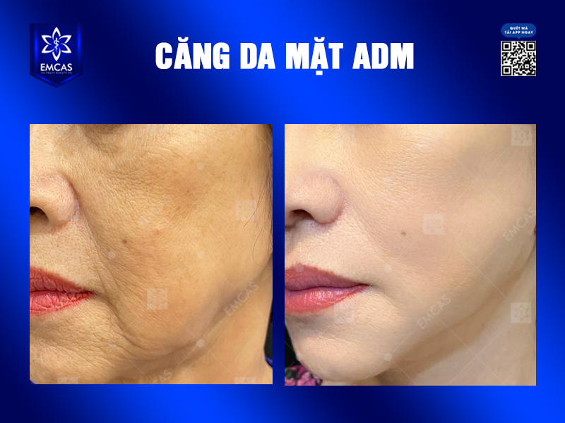 Căng Da Mặt ADM Có Thật Sự Hiệu Quả Trong Việc Trẻ Hóa Khuôn Mặt?