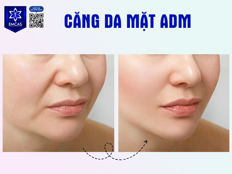 Căng Da Mặt ADM Là Gì? Tất Tần Tật Những Điều Bạn Cần Biết