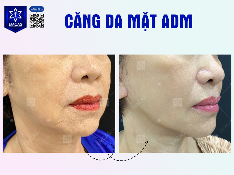 Căng Da Mặt ADM Là Gì? Tất Tần Tật Những Điều Bạn Cần Biết