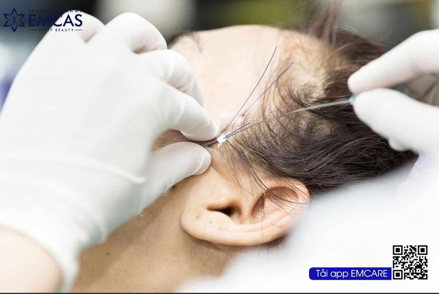 Căng Da Mặt Bằng Chỉ Có Thật Sự Hiệu Quả Không?