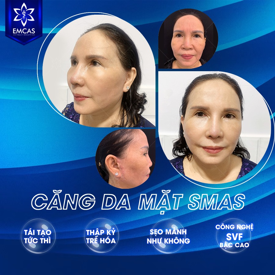 Căng Da Mặt Có Thật Sự An Toàn?