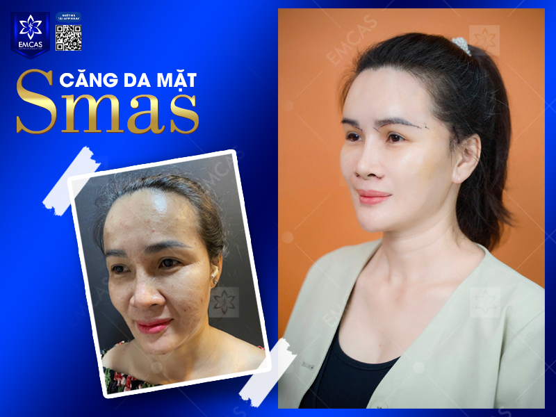 Làm Thế Nào Để Giúp Kéo Dài Hiệu Quả Căng Da Mặt?
