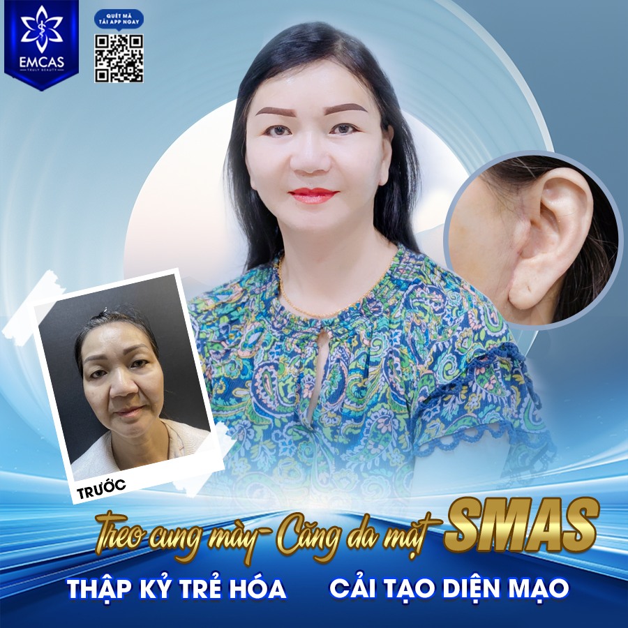 Căng Da Mặt Có Thật Sự Hiệu Quả