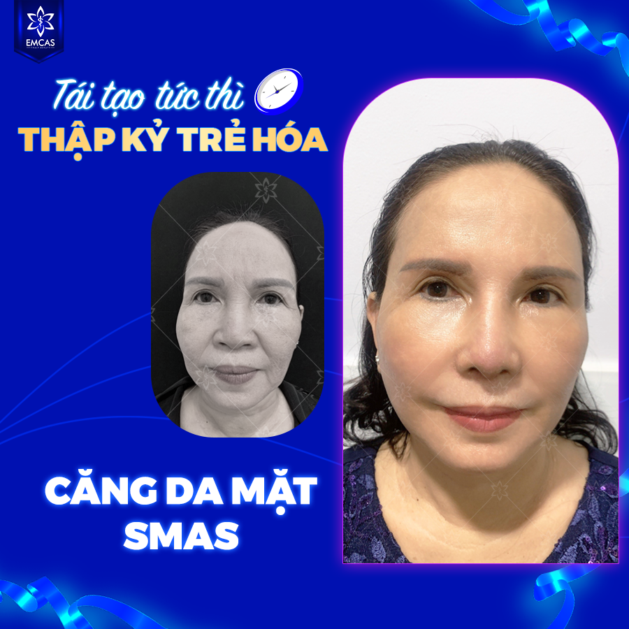 Căng Da Mặt SMAS - Bí Quyết Giữ Gìn Thanh Xuân