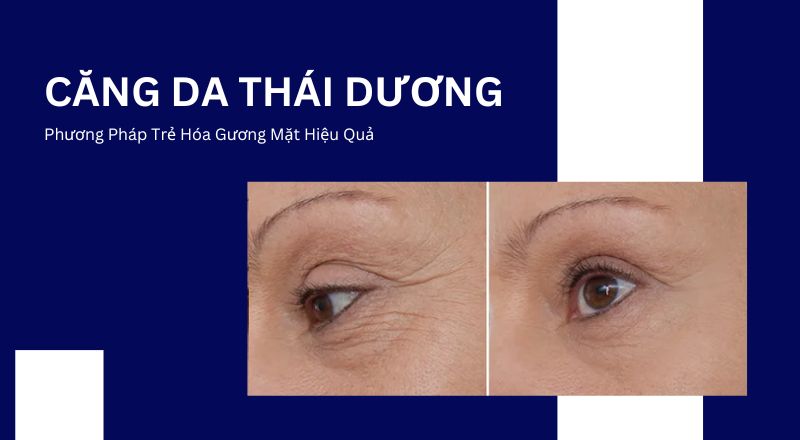 Căng Da Thái Dương - Phương Pháp Trẻ Hóa Gương Mặt Hiệu Quả