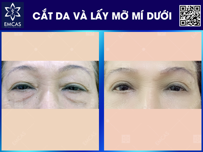CẮT DA VÀ LẤY MỠ MÍ DƯỚI