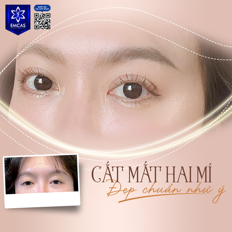 Phương Pháp Cắt Mí Mắt Hiện Đại: An Toàn, Hiệu Quả Và Không Đau Đớn