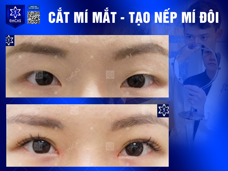 Phương Pháp Cắt Mí Mắt Hiện Đại: An Toàn, Hiệu Quả Và Không Đau Đớn