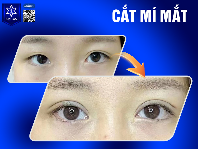 Cắt Mí Có Để Lại Sẹo Không? Cách Chăm Sóc Để Mí Đẹp Tự Nhiên