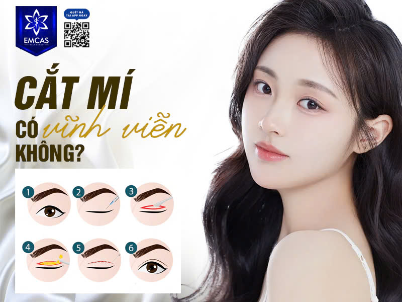 Cắt Mí Có Vĩnh Viễn Không