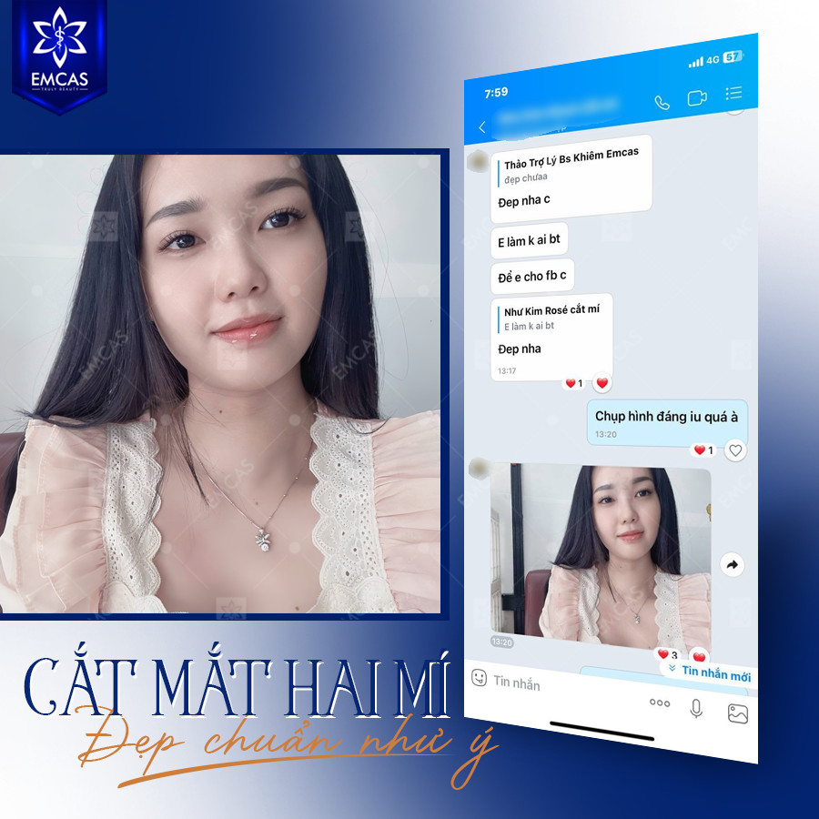 Cắt Mí Mắt Có Đau Không? Những Lưu Ý Quan Trọng Sau Phẫu Thuật