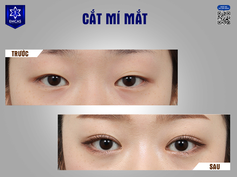Cắt mí