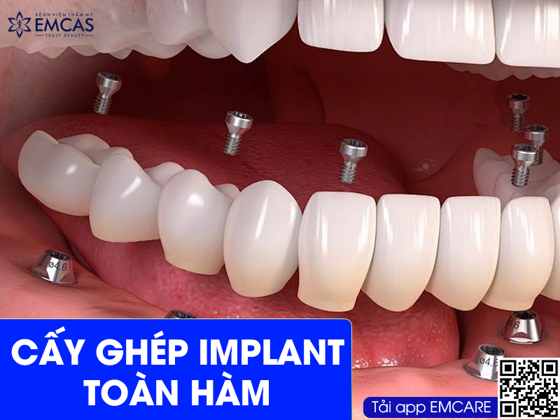CẤY GHÉP IMPLANT TOÀN HÀM
