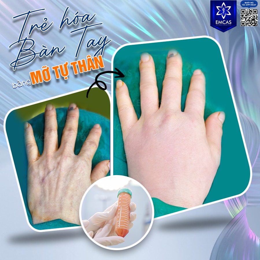 Cấy Mỡ Tự Thân Là Gì? Có Nên Thực Hiện Không?